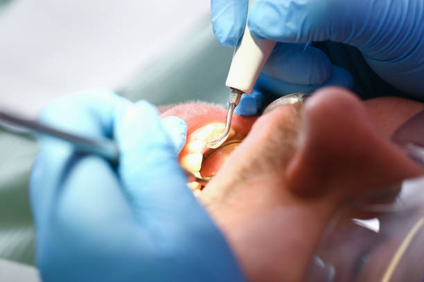 Best Emergency Dental Extractions in Safety Harbor, FL